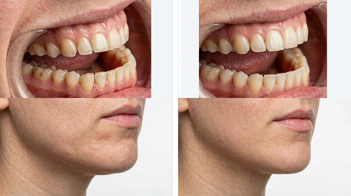Bruxismus Botox: Vorher-Nachher, Kosten und Alternativen